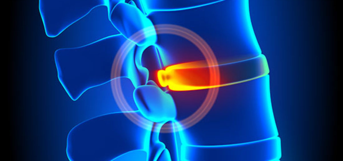 ozonoterapia ernia